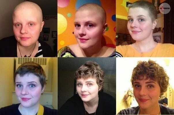 Прически после химиотерапии для женщин One year after chemotherapy. The essence of chemotherapy is that special drugs e