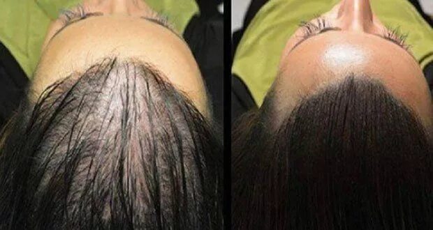 Прически растут волосы Oui, l’huile de ricin fait repousser les cheveux Faire repousser les cheveux, Pe