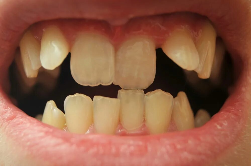 Причина на зубов фото Pin on figure in 2024 Teeth aesthetic, Natural teeth whitening, Crooked teeth