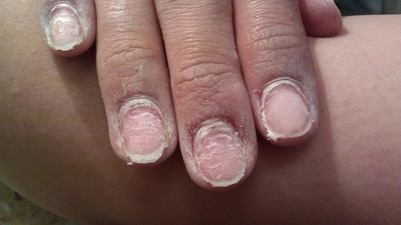 Причина ногтях фото What 10 years of wearing gel/acrylic do to your nails xoxo Emmy Gel nails pictur