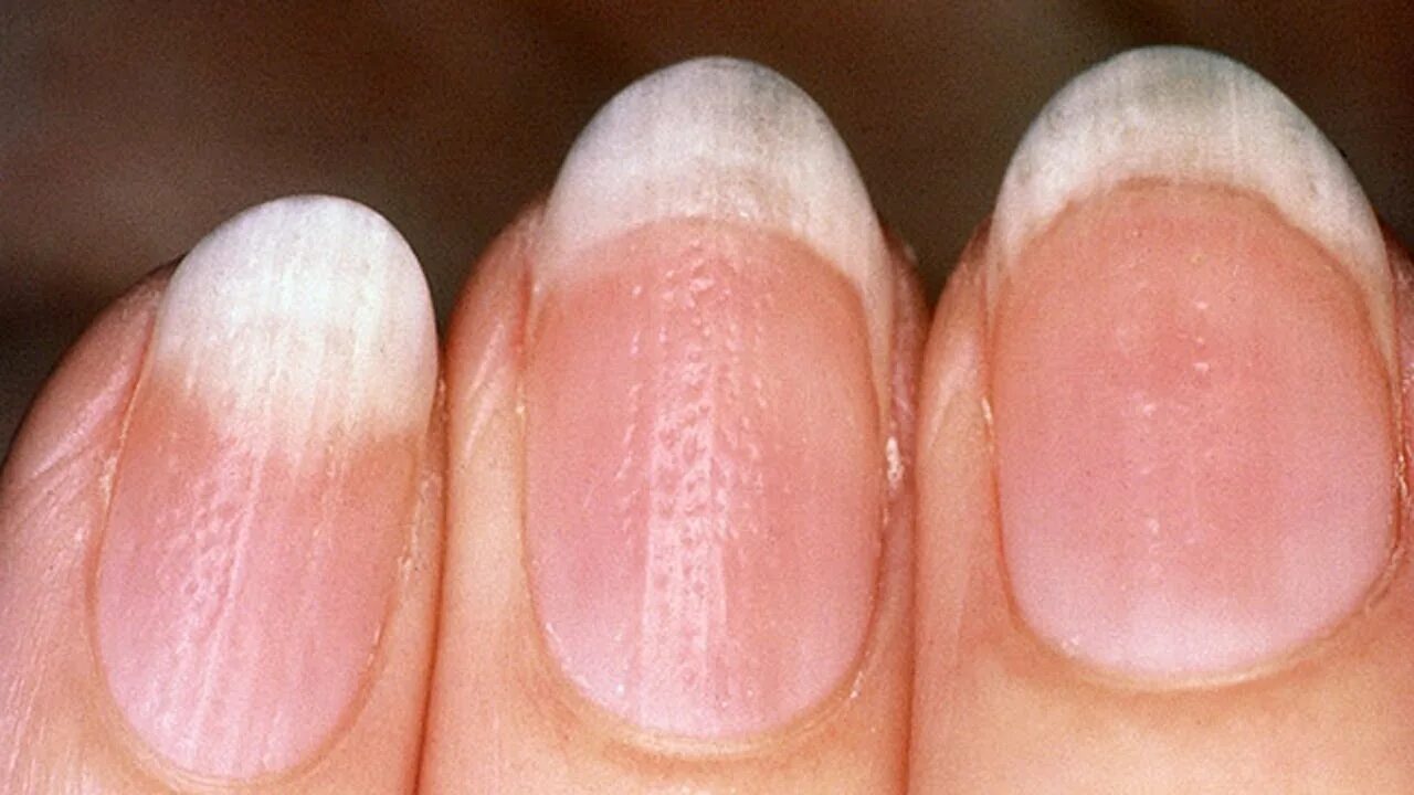 Причина ногтях фото What Causes Ridges in Finger & Toenails! what does it mean having vertical ridge