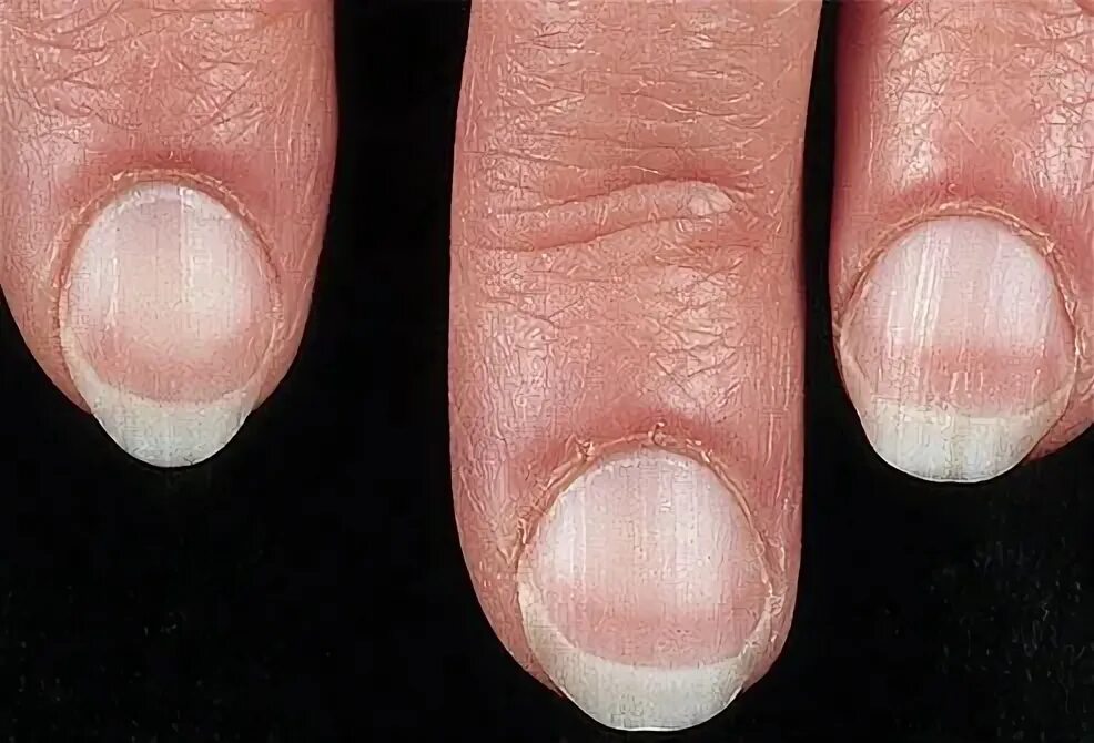 Причина ногтях фото Clues about your health, from your fingernails. Interesting to know, Fingernail 