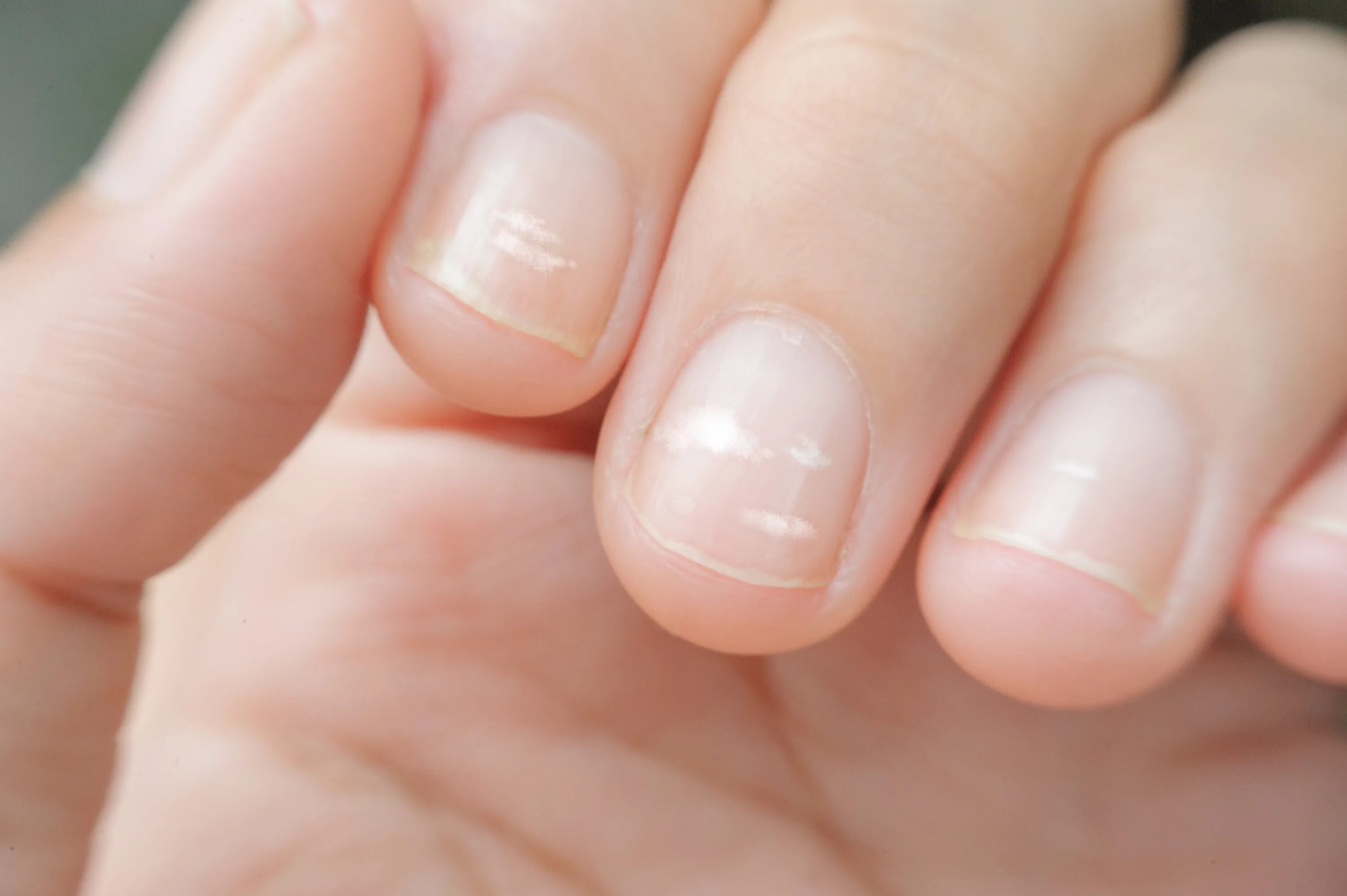 Причина ногтях фото What Can Nail Changes Say About Our Health? Here's What To Know IFLScience