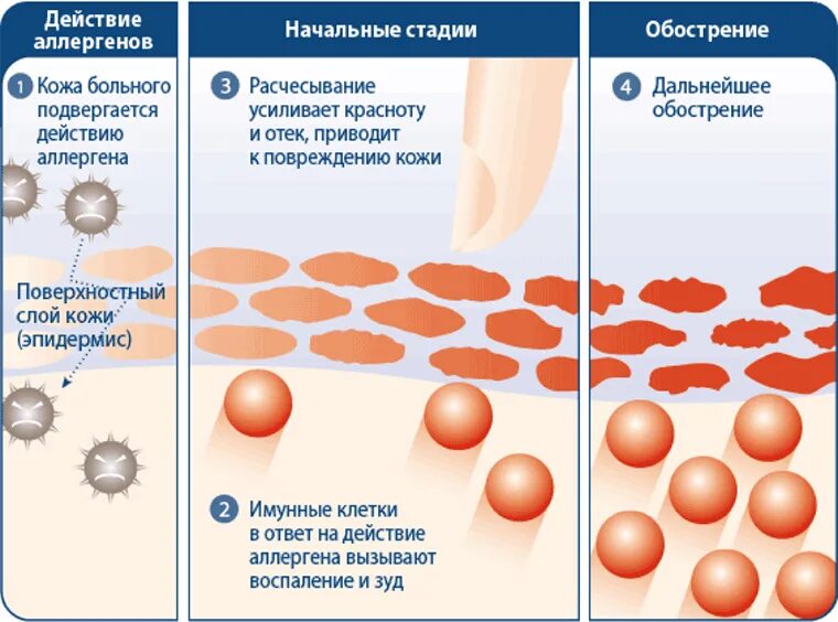 Причины атопического дерматита у взрослых фото Лечение атопического дерматита Клиника АЛОДЕРМ Москва