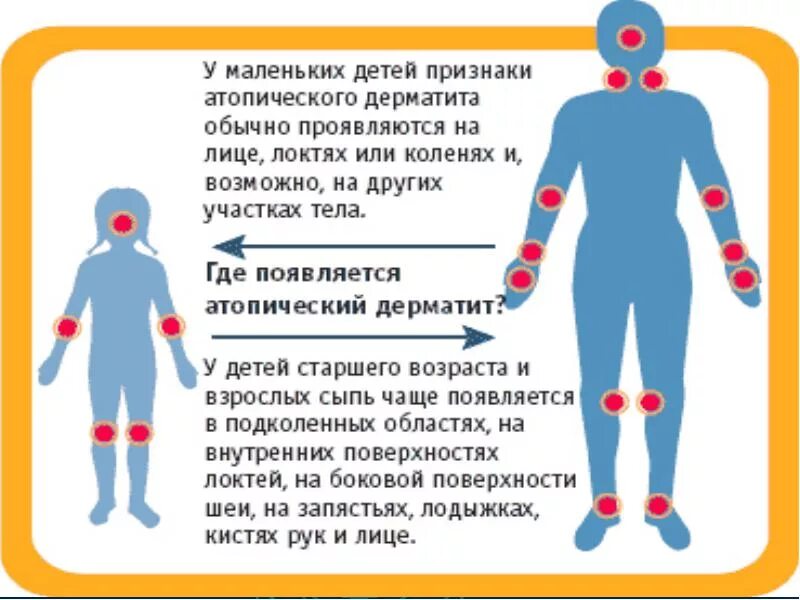 Причины атопического дерматита у взрослых фото Атопический дерматит у детей: причины, симптомы, методики лечения - медикаментоз