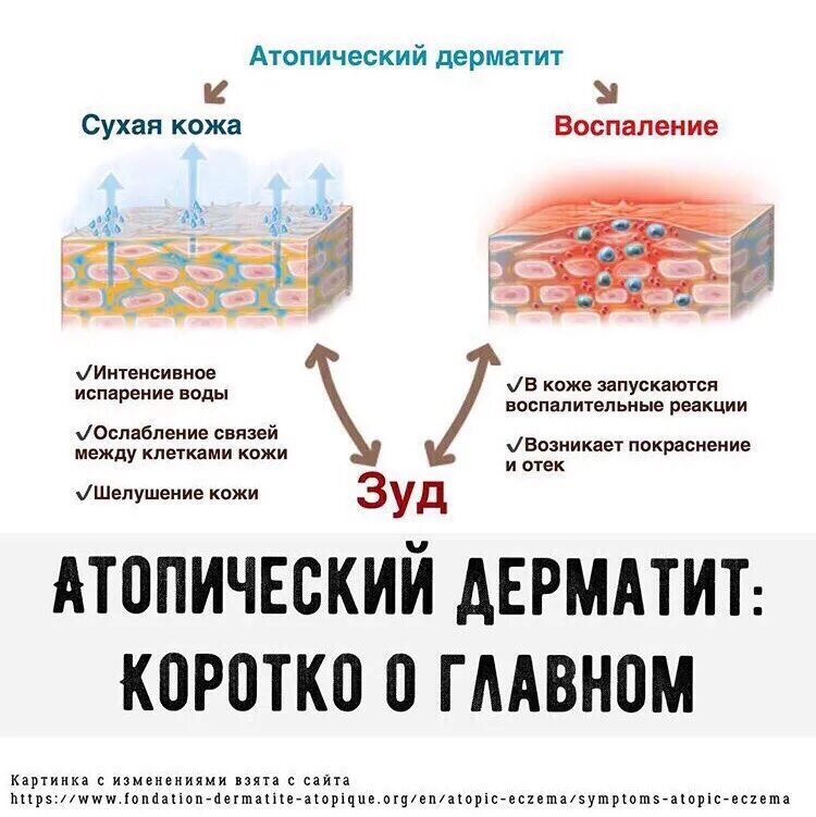 Причины атопического дерматита у взрослых фото Через сколько проходит аллергический дерматит - фото презентация