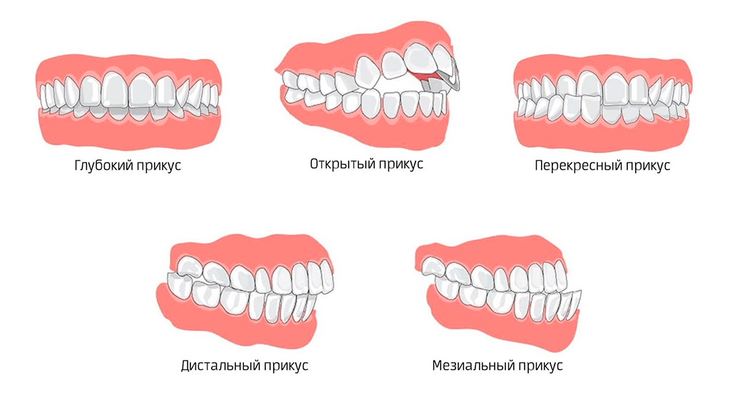 Прикус зубов фото Нейромышечная стоматология в Москве - цена услуг Клиника "Французский стандарт"