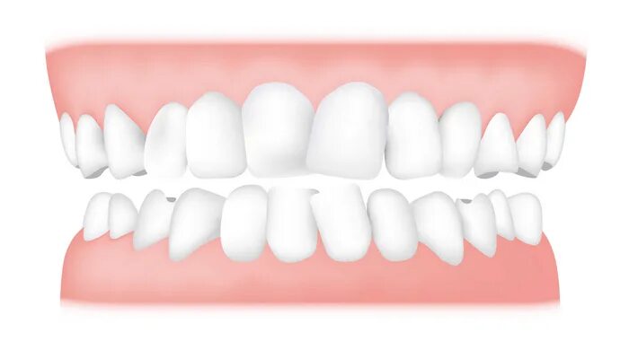 Прикус зубов фото Импланты для ортодонтической коррекции прикуса подросткам Добромед