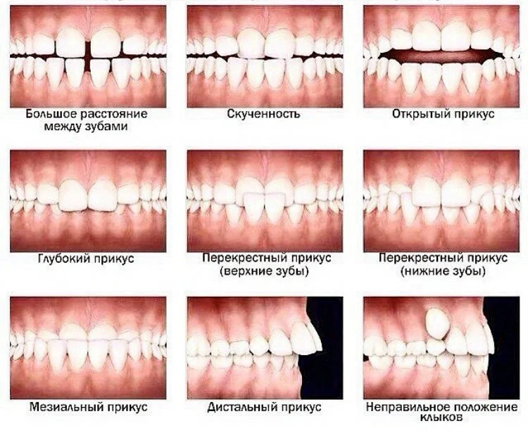 Прикус зубов правильный и неправильный фото Брекеты
