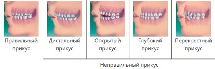 Прикус зубов правильный и неправильный фото Как исправить неправильный прикус? - Триомед