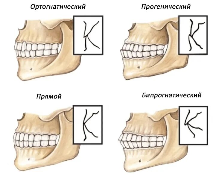 Прикус зубов правильный и неправильный фото Исправление прикуса ортодонтическими методами, стоимость лечения Дентал Мир