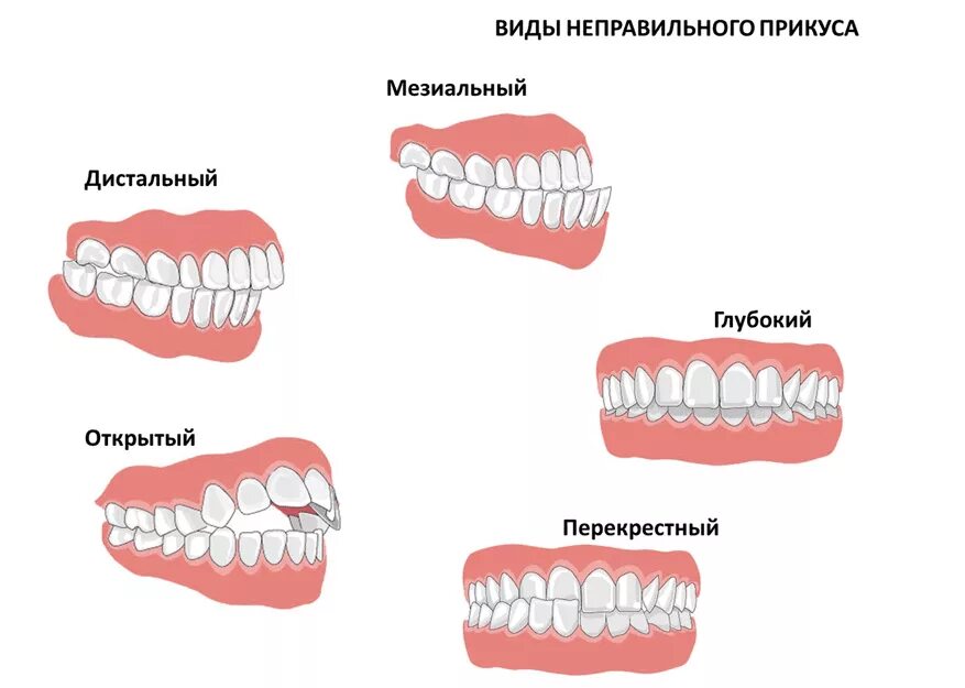 Прикус зубов правильный у взрослого фото Исправление прикуса у детей в стоматологической клинике Genesis