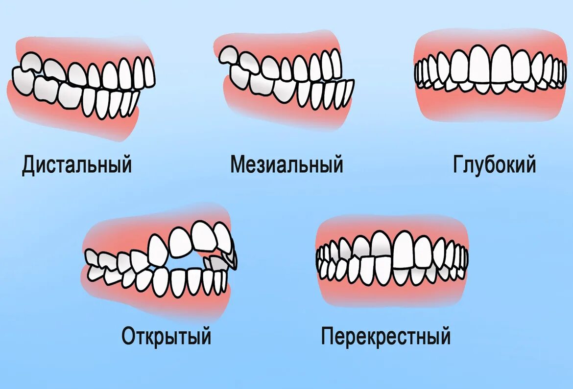 Прикус зубов правильный у взрослого фото Аномалии роста зубов - Вита 3D