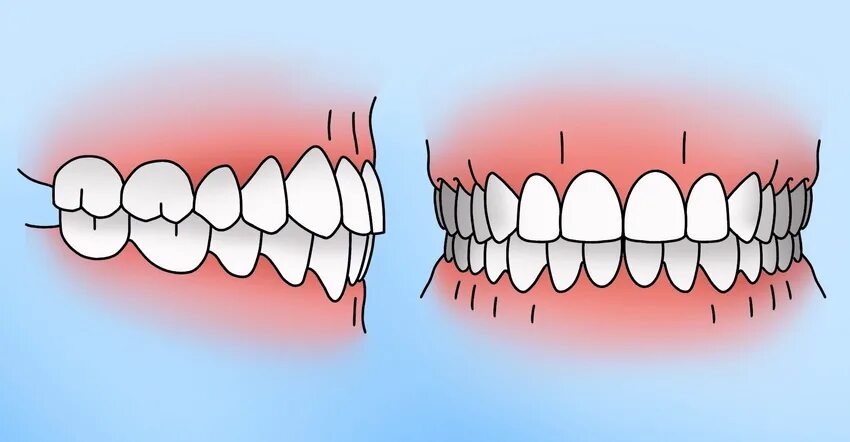 Прикус зубов правильный у взрослого фото Правильный прикус у человека: признаки, причины искажения и способы коррекции