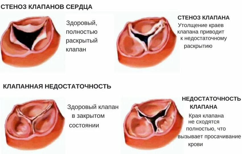 Приобретенные пороки сердца фото Стеноз что это и как лечить: найдено 73 изображений