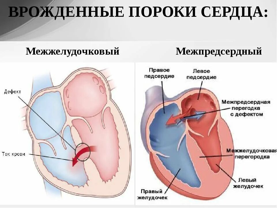 Приобретенные пороки сердца фото Дефект, стеноз, недостаточность. Обнаружили порок сердца, и что с этим делать? И