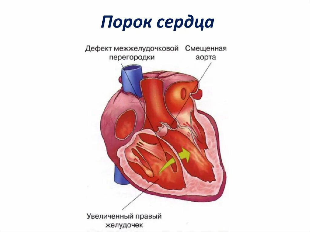 Приобретенные пороки сердца фото Первый порок сердца