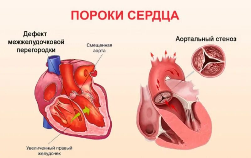 Приобретенные пороки сердца фото Пороки сердца