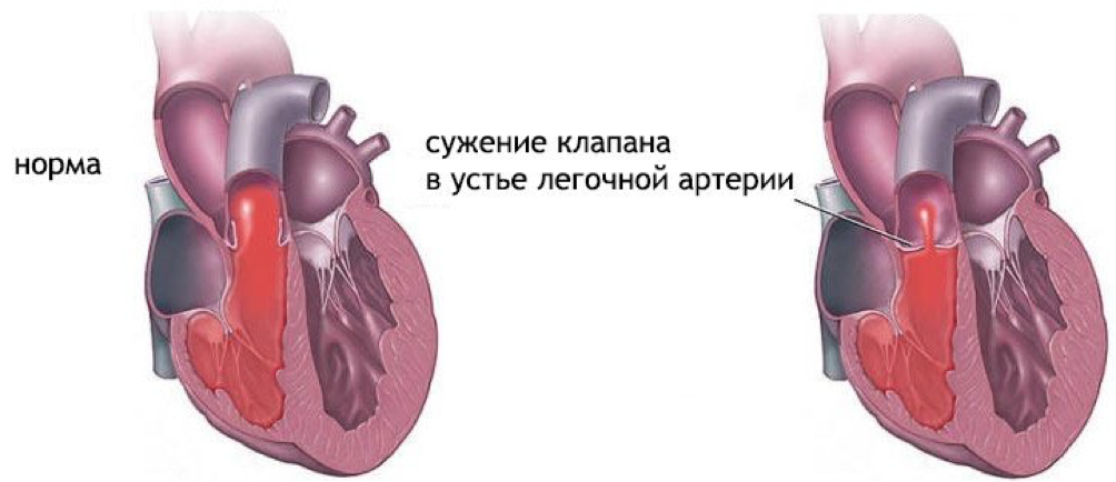 Приобретенные пороки сердца фото Впс легочной артерии