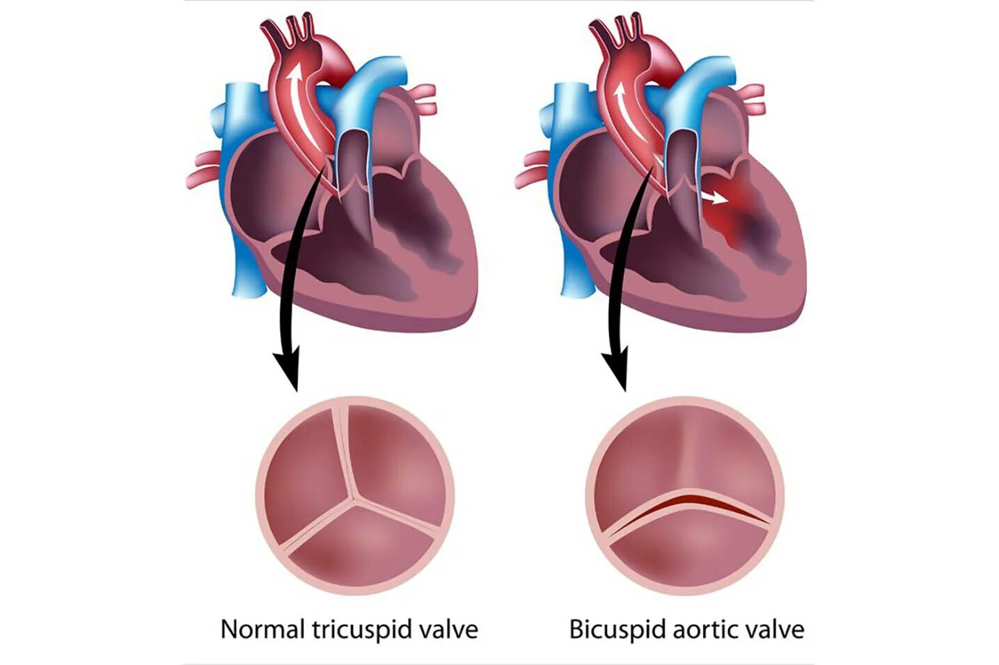 Приобретенные пороки сердца фото Bicuspid Aortic Valve Conditions & Treatments UR Medicine