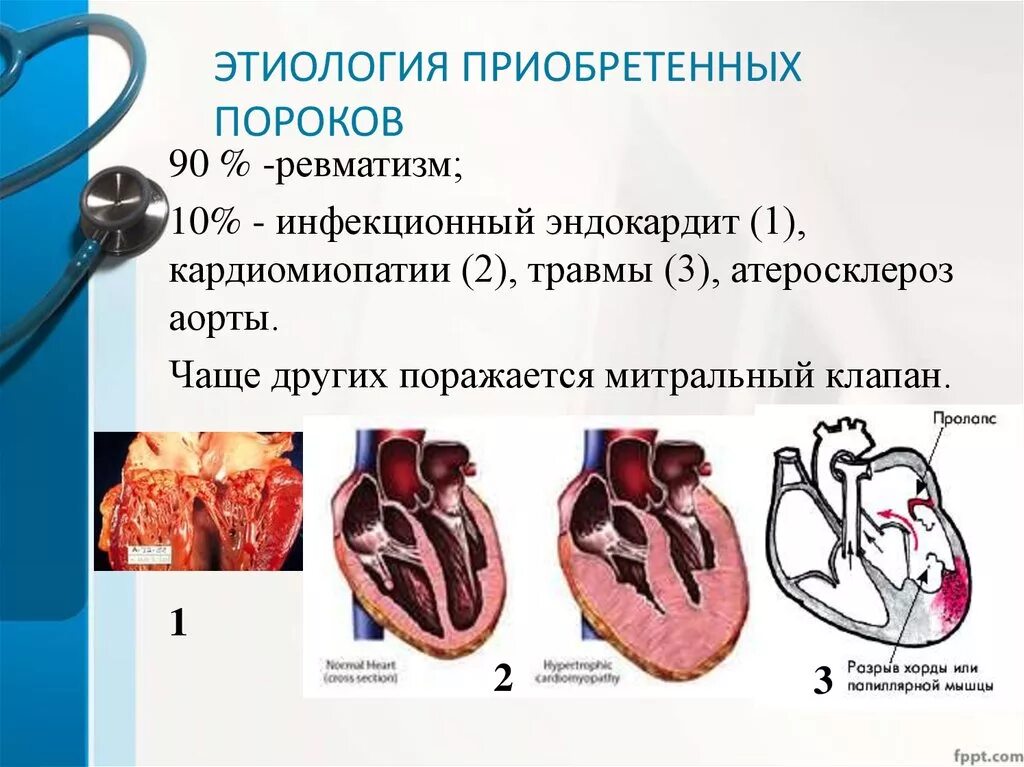 Приобретенные пороки сердца фото Причины приобретенных пороков сердца тест