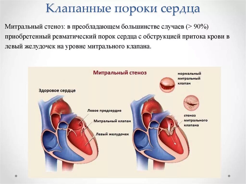 Приобретенные пороки сердца фото Картинки МИТРАЛЬНЫЙ ПОРОК СТЕНОЗ НЕДОСТАТОЧНОСТЬ МИТРАЛЬНОГО КЛАПАНА