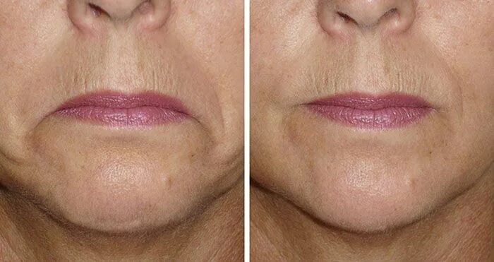 Приподнять уголки губ макияжем Grumpy mouth lines can be easily treated with Botox. Turn downward lines into an