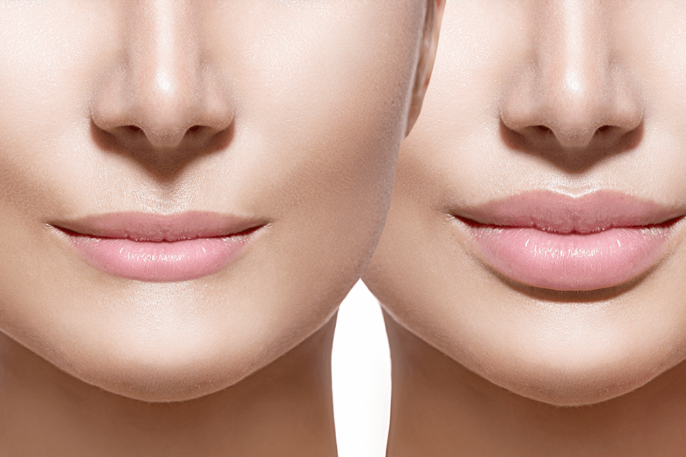 Приподнять уголки губ макияжем Derm Fillers: Belotero ® / Radiesse ® / Restylane ® / Versa ® - Skin Body Health