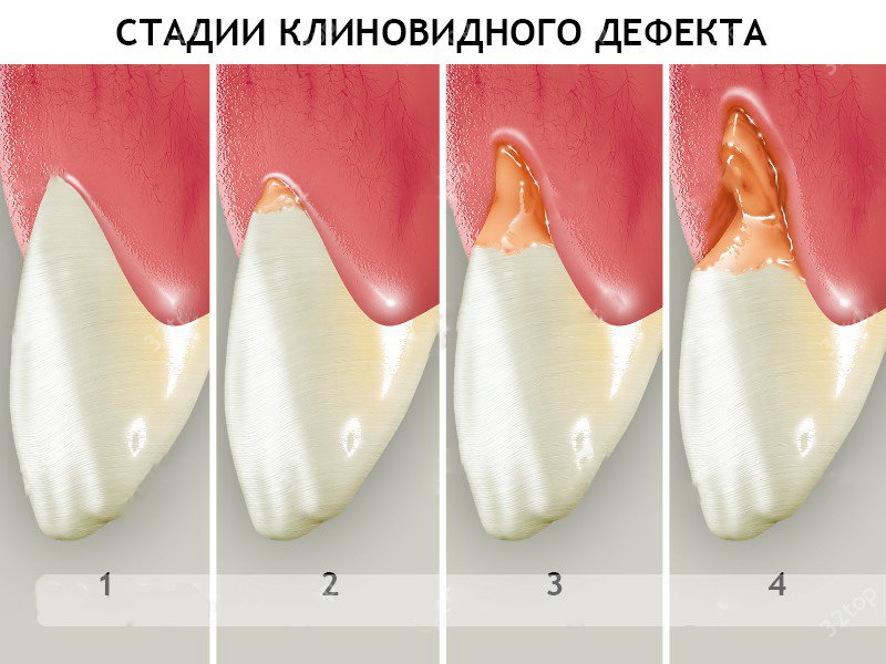 Пришеечный кариес стадии фото Лечение клиновидных дефектов зубов в клинике Dentserv: причины, методы, професси