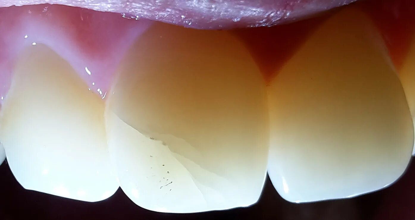 Пришеечный кариес стадии фото dentistry - How dangerous are cracked teeth? - Medical Sciences Stack Exchange