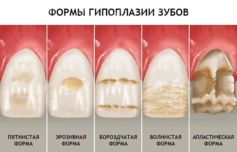 Пристли налет на зубах фото Белые пятна на зубах: причины и последствия