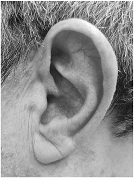 Признак франка на мочке уха фото Diagonal earlobe crease Download Scientific Diagram