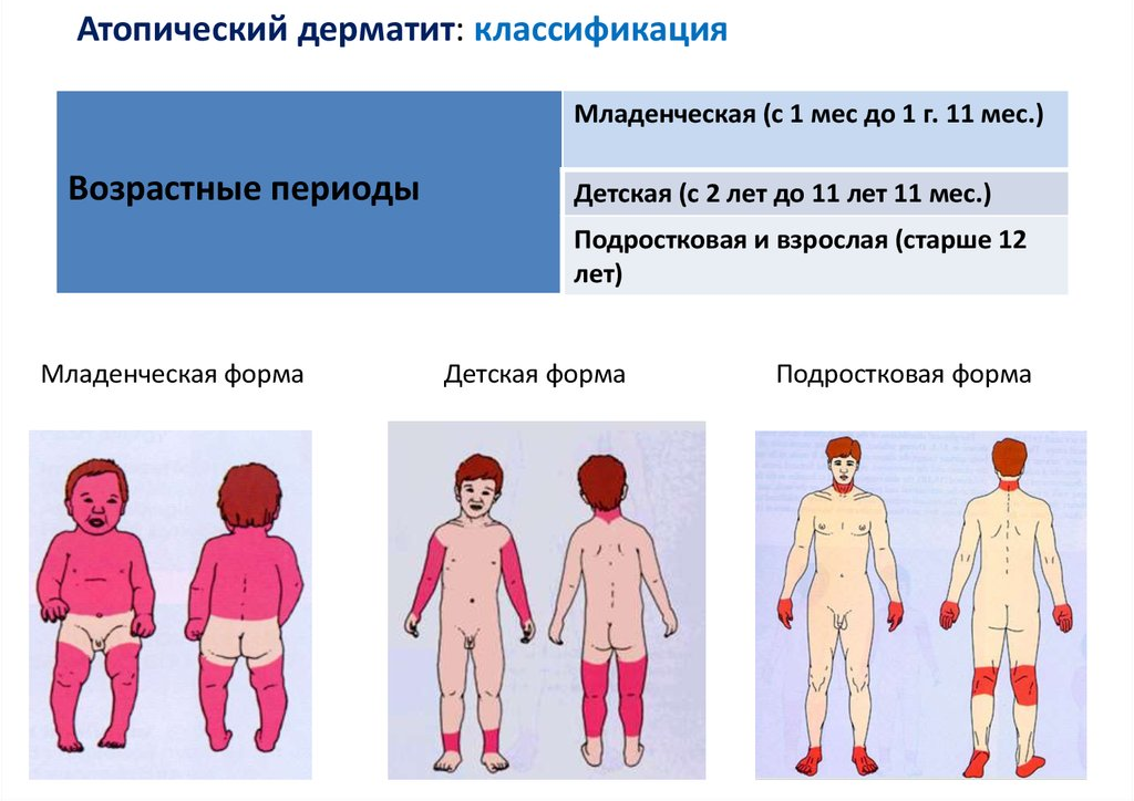 Признаки атопического дерматита фото Атопический дерматит med.bloknot Дзен