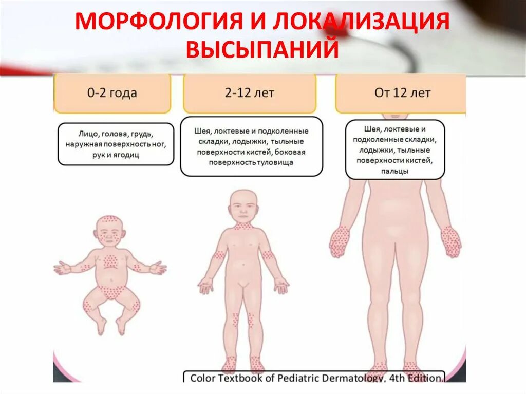 Признаки атопического дерматита фото Картинки АТОПИЧЕСКИЙ ДЕРМАТИТ ТИПЫ