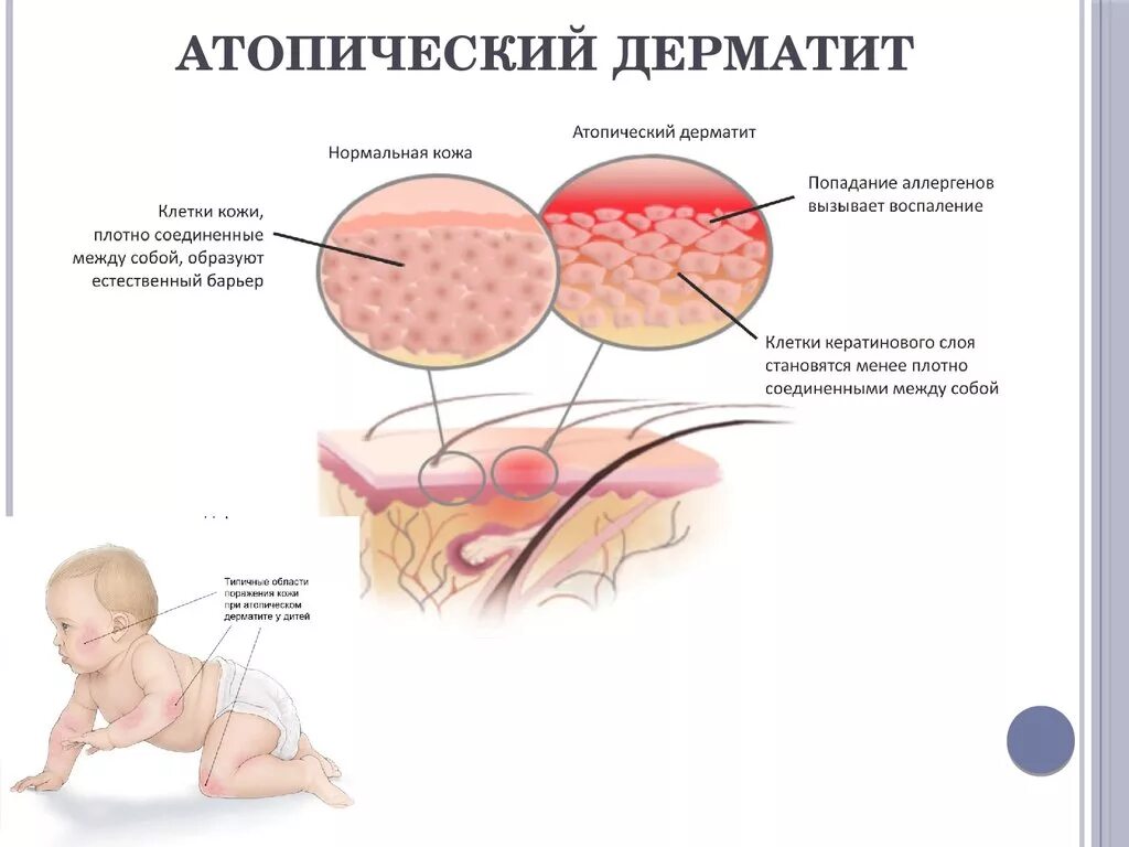 Признаки атопического дерматита фото Дерматит и экзема при грудном вскармливании: симптомы и лечение