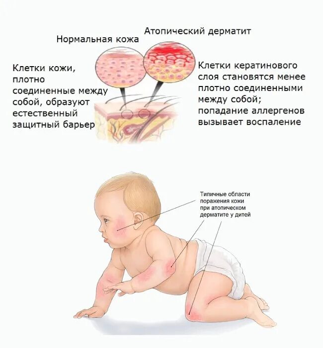 Признаки атопического дерматита фото Атопический дерматит у детей: красные щеки, корки на лице и теле, проблемы с едо