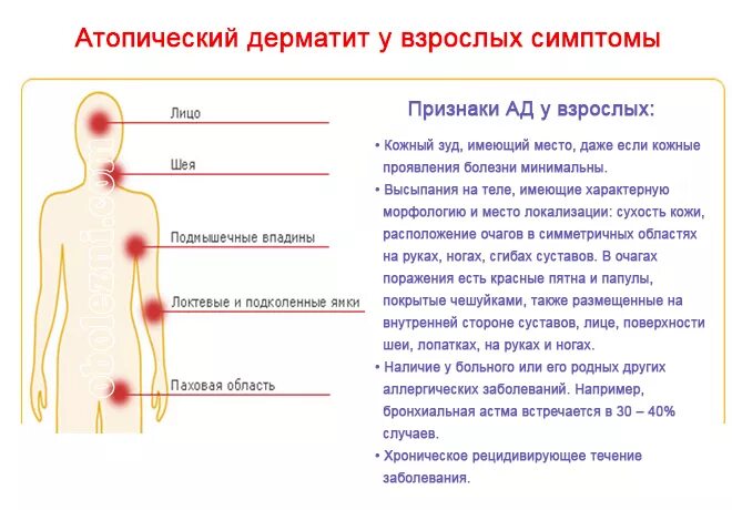 Признаки атопического дерматита фото Атопический дерматит: заболевания кожи: диагностика, лечение, профилактика