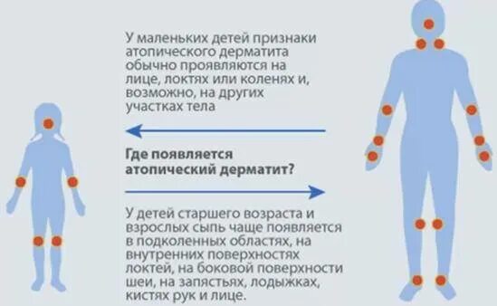 Признаки атопического дерматита у взрослых фото Бады при атопическом дерматите