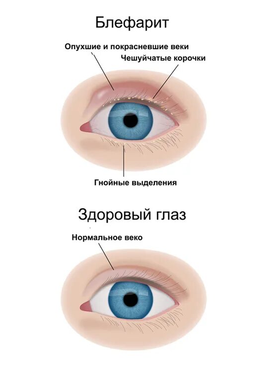 Признаки блефарита глаз фото Блефарит - диагностика и лечение в клинике Vizia