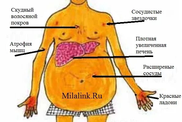 Признаки болезни печени фото Первые симптомы цирроза печени