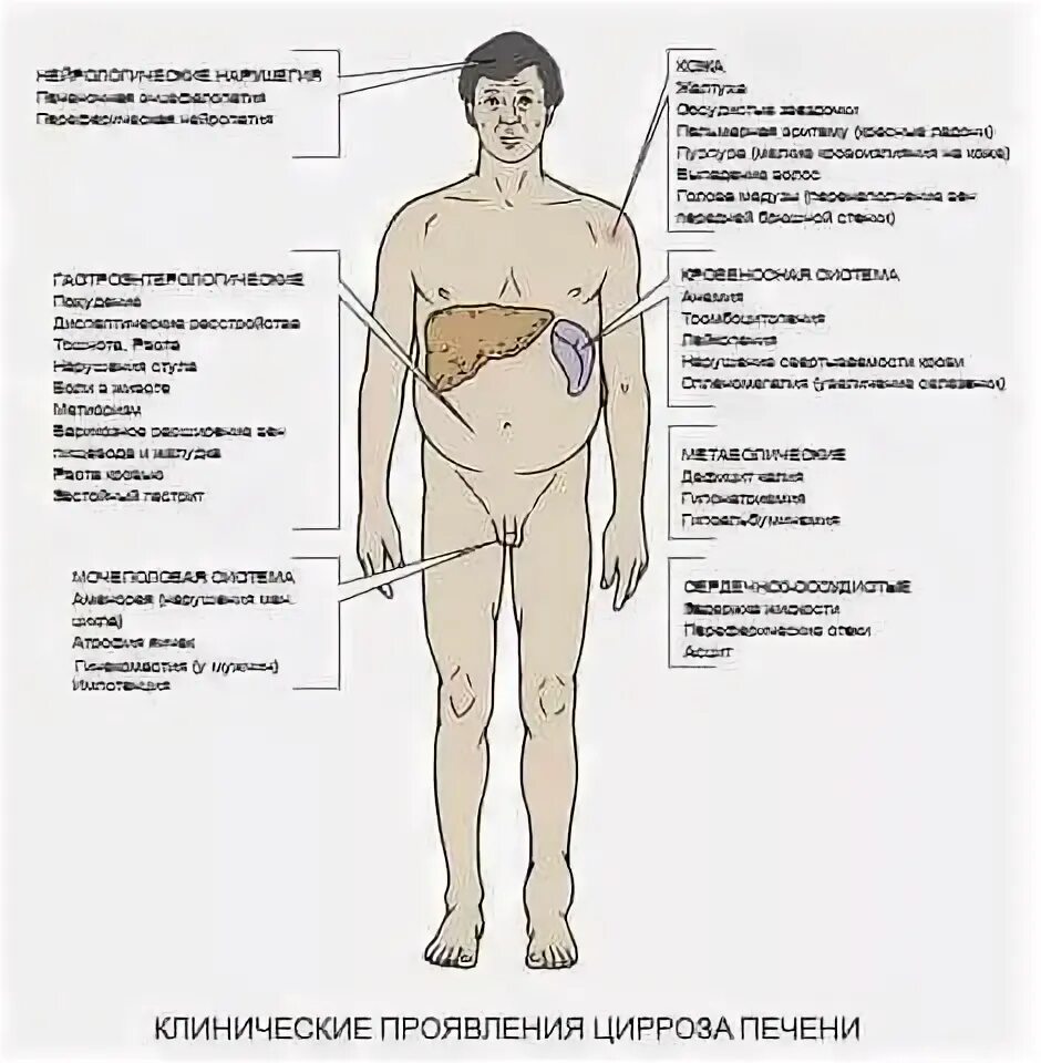 Признаки болезни печени фото Цирроз симптомы у мужчин сколько живут