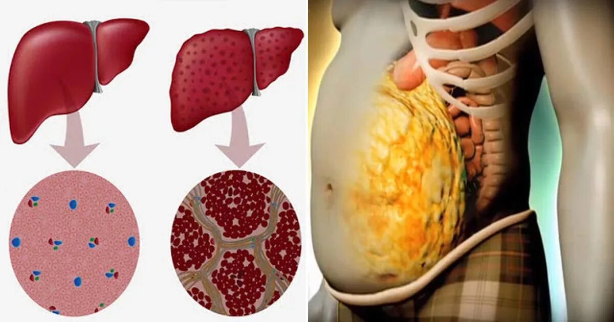 Признаки болезни печени фото Почему развивается цирроз печени: далеко не всегда проблема только в алкоголе О 