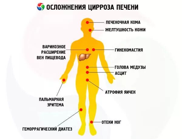 Признаки болезни печени фото Цирроз печени: симптомы и лечение, как ставится диагноз цирроз печени, стадии ци