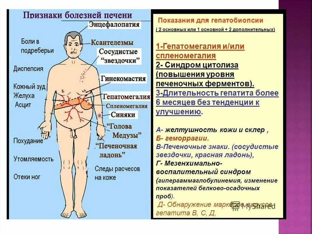 Признаки болезни печени фото Лечении болезней печени у женщин - найдено 77 картинок