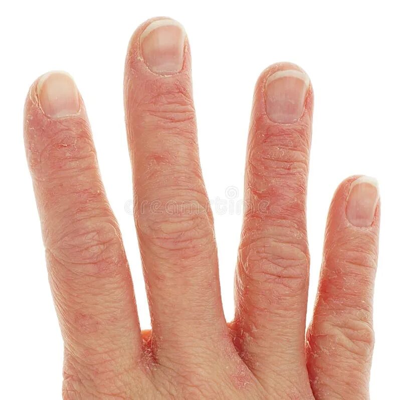 Признаки дерматита на руках фото начальная Closeup of Eczema Dermatitis on Fingers Stock Image - Image of health, healthcar