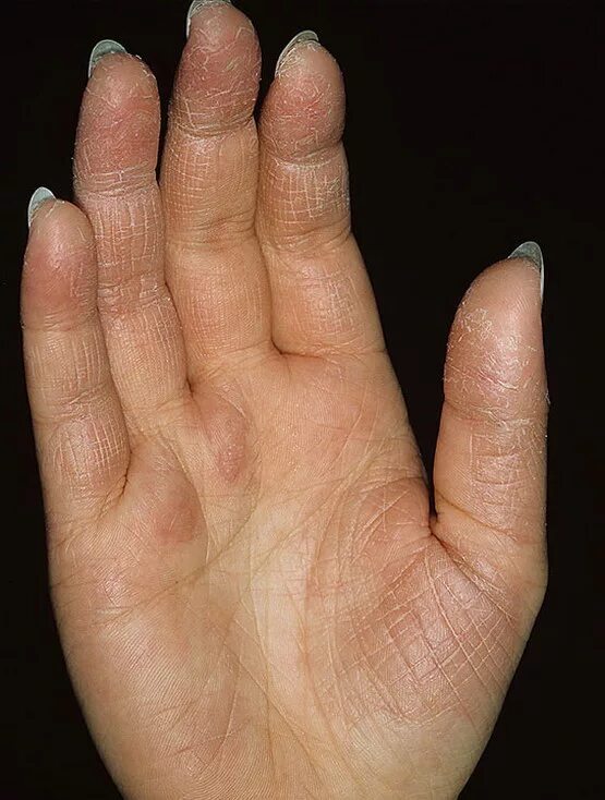 Признаки дерматита на руках фото начальная Dry Eczema on Hands Pictures - 475 Photos & Images / illnessee.com