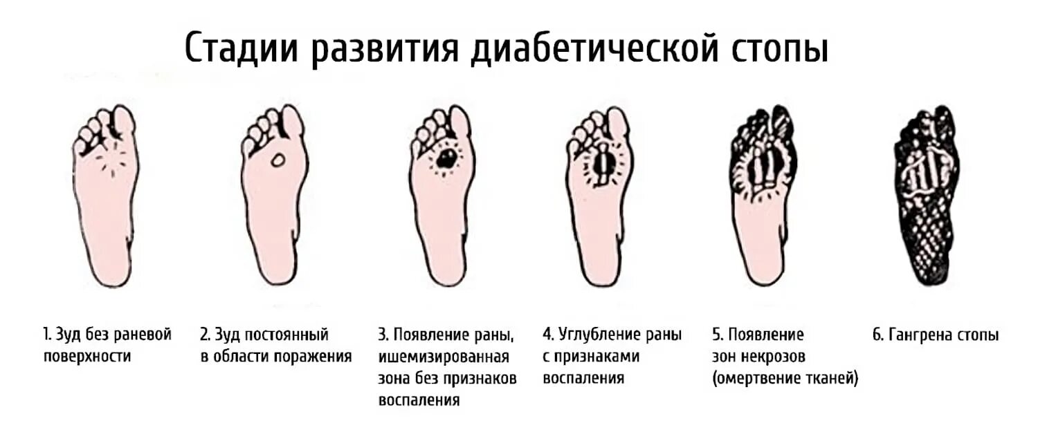 Признаки диабетической стопы фото симптомы Лечение диабетической стопы в Твери - Клиника "Медицина", г.Тверь