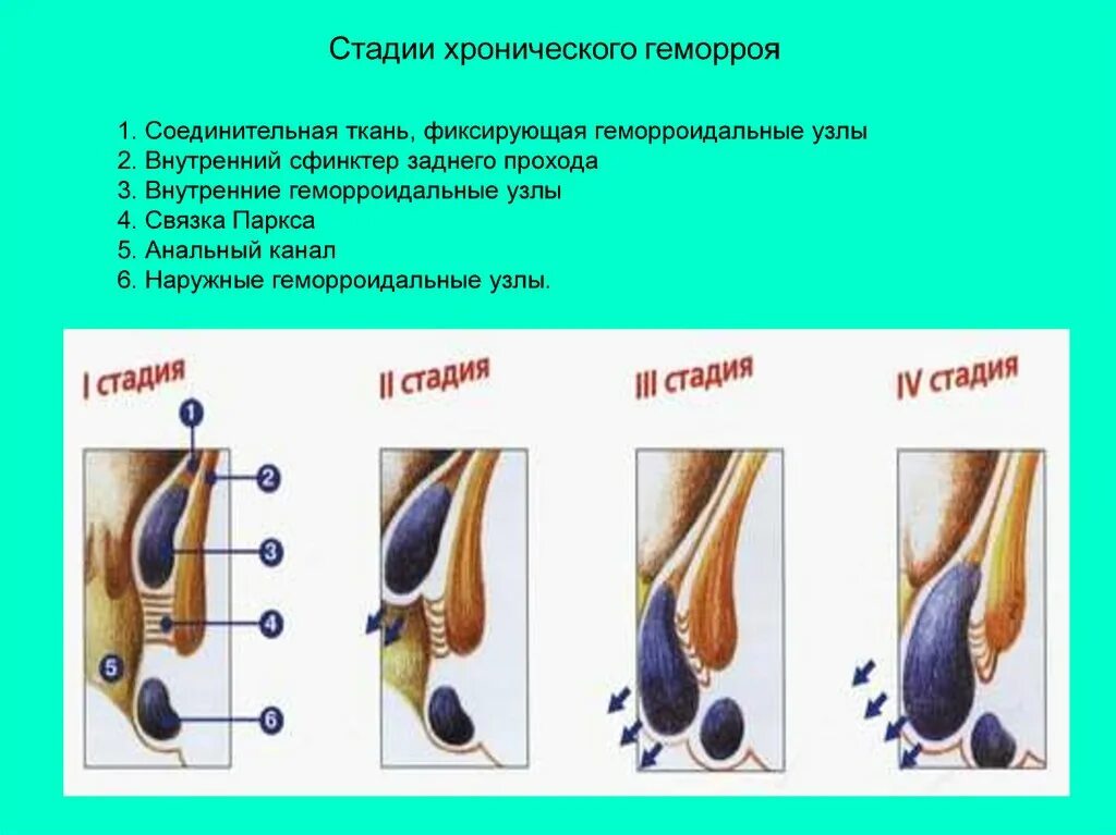 Признаки геморроя как выглядит Схемы лечения тромбоза геморроидальных узлов