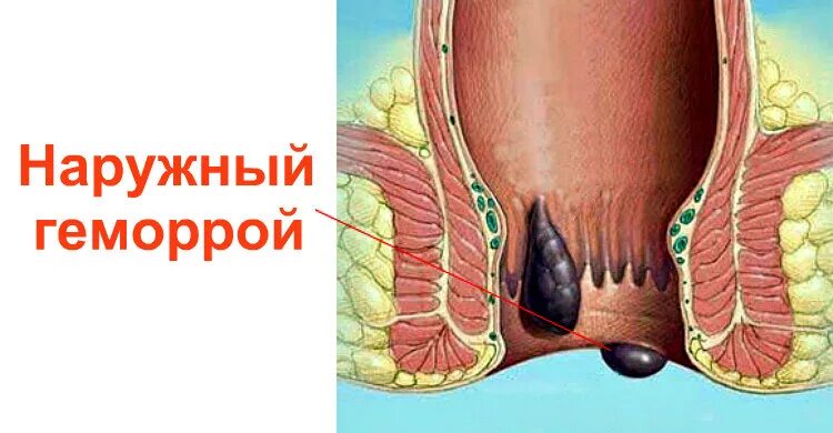 Признаки геморроя как выглядит Картинки СИНИЙ ЗАДНИЙ ПРОХОД