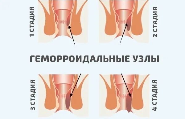 Признаки геморроя как выглядит Стадии геморроя, фото, как выглядит геморрой Причины, симптомы и лечение